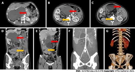 Pdf Giant Teratoma With Isolated Intestinal Duplication In Adult A