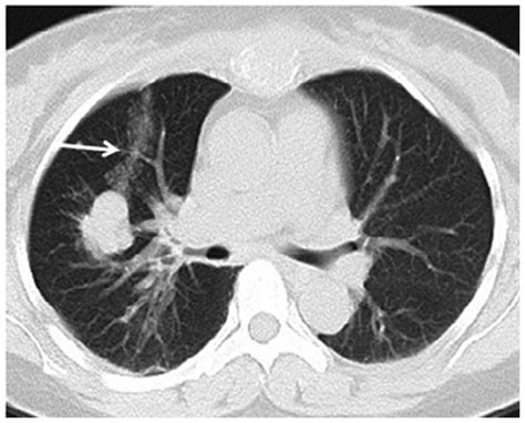 Computed Tomography Guided Core Needle Biopsy Of Lung Lesions Diagnostic Yield And Correlation