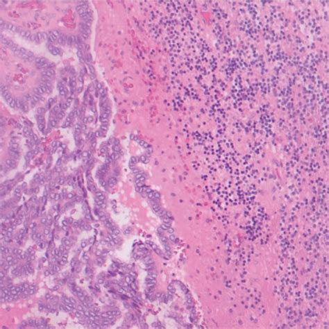 Metastatic Papillary Thyroid Carcinoma In Cerebellar Tissue