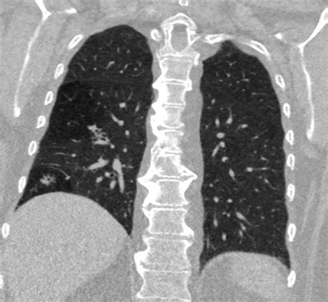 000 Mosaic Attenuation Pattern | Lungs