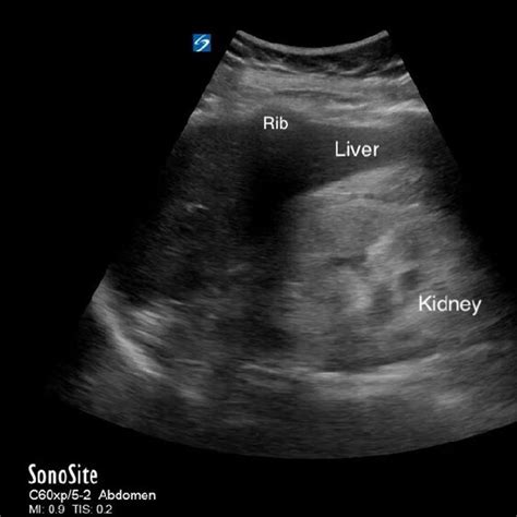 Hyperechoic kidney seen in a patient with chronic kidney disease. Note... | Download Scientific ...