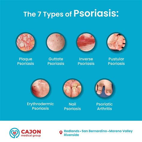🔴Plaque psoriasis is the most common... - Cajon Medical Group