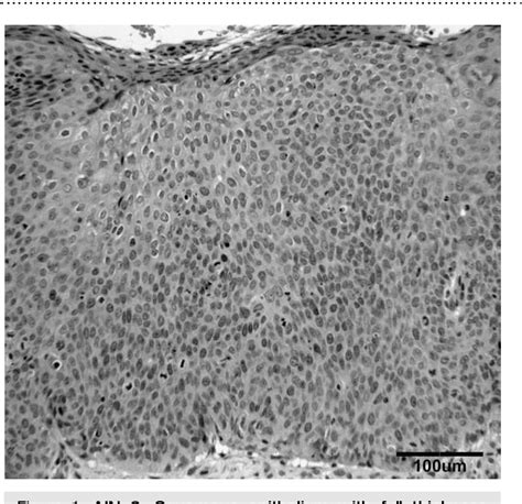 Figure 1 From The Frequency Of High Grade Intraepithelial Neoplasia In Analperianal Warts Is