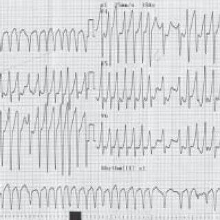 AF in WPW. Note irregularly irregular rhythm with delta wave visible in ...