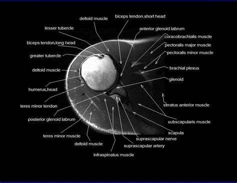 Mri Shoulder Cross Sectional Anatomy Axial Image 10 Shoulder Anatomy Radiology Imaging Mri