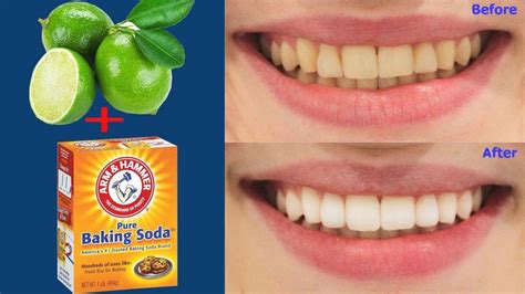 Just In 3 Minutes To Get Rid Of Yellow Teeth With Home Remedies Youtube