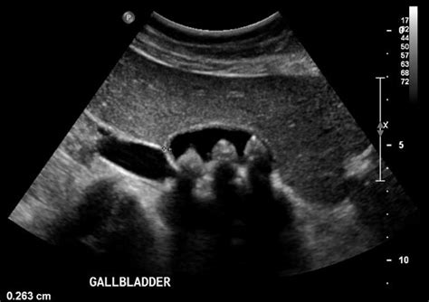 Gallbladder Ultrasound Stones