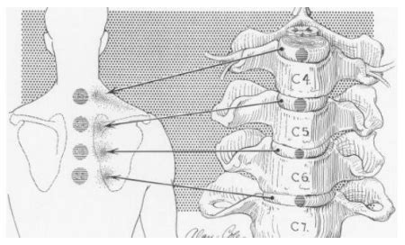 Ortho Cervical Spine Flashcards Quizlet