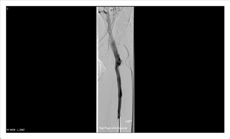 Venography Post Angiojet Thrombectomy The Superficial And Common Download Scientific Diagram