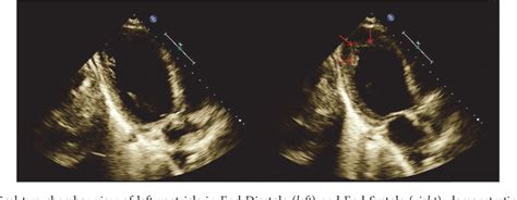 Figure 3 From A Case Of Reverse Takotsubo Cardiomyopathy Incited By A