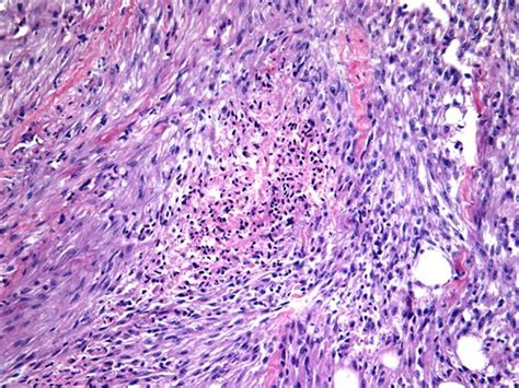 Anaplastic Thyroid Cancer Histology Cancerwalls