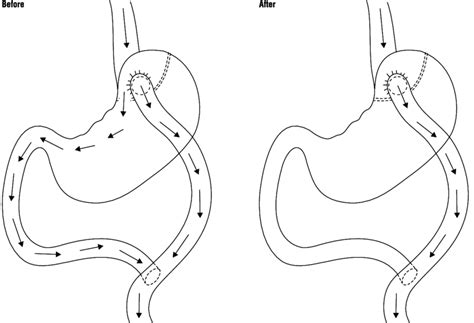 Before — Preoperative Two Routes Passage Roux Loop And Alternative Way