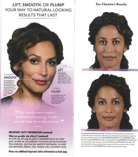 Facial Fillers Juvederm York Pa Keystone Eye Care Group