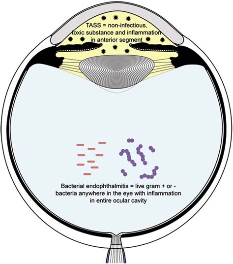 Figure 1 From Toxic Anterior Segment Syndrome Semantic Scholar