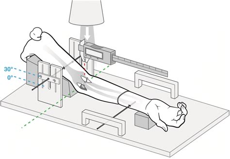 Schematic illustration of the custom-made fixation device. In this ...