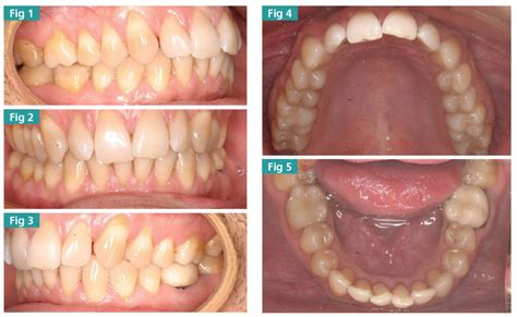 Updating The Ca Clear Aligner Therapy Dental Jay