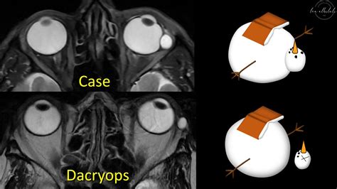 Lea Alhilali, MD on Twitter: "3/On axial images, the cystic structure & the globe looked like a ...