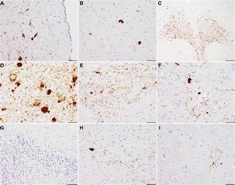 Representative Images Of Tau Pathology In Subcortical Grey Matter In