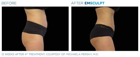 Butt Lift Alternative | Emsculpt McLean | Cosmetic Dermatology Center