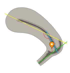 angle  anteversion  anatomy imaios