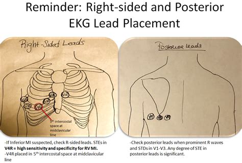 Back To Basics Ecg Findings In Acute Myocardial Infarction