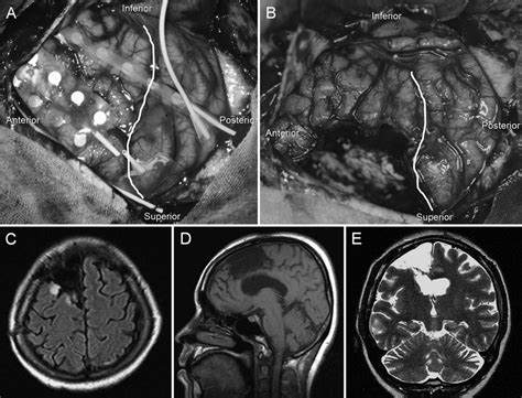 cingulate gyrus | Neurosurgery Blog