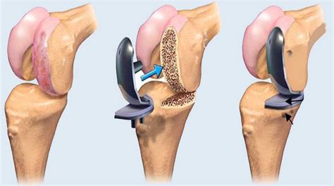 Whats A Knee Replacement Surgery Performed At Orthopedic Hospital In