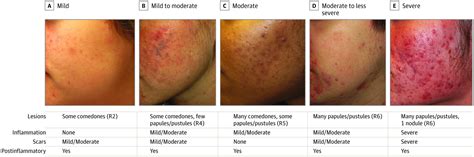 Development And Initial Validation Of A Multidimensional Acne Global