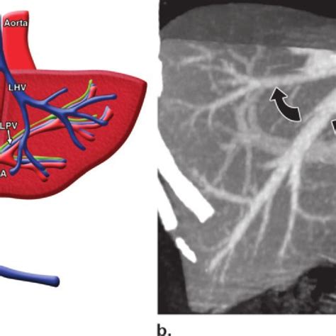 Hepatic Venous Anatomy A Illustration Shows The Venous And Arterial