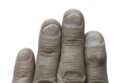 Nail Psoriasis: Causes, Symptoms, Diagnosis, Treatment