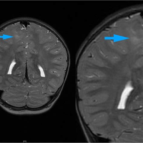 Magnetoencephalography Images Yellow Arrows Indicate Interictal