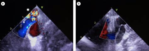 Color Doppler Echocardiography A Preoperative Image Showing