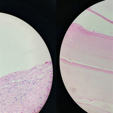 Histopathology Image Showing Acellular Laminated Hydatid Cyst Membrane Download Scientific