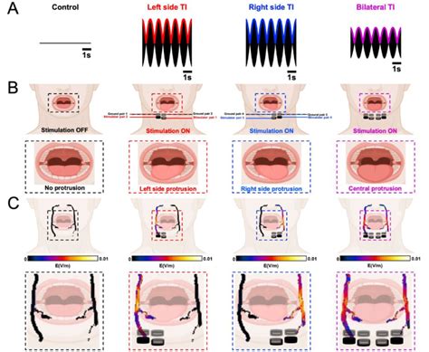 Bilateral Hypoglossal Nerve Stimulation Reduces Stimulation Amplitudes