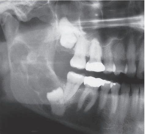 Calcifying Epithelial Odontogenic Tumor Medizzy