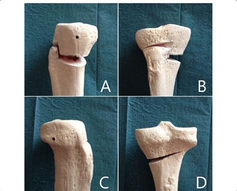 Reproduction Of Z Shaped Biplanar Medial Opening Wedge High Tibia