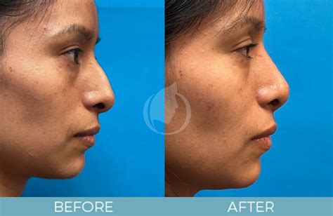 Revision Rhinoplasty Atlanta Ga Secondary Rhinoplasty Near You