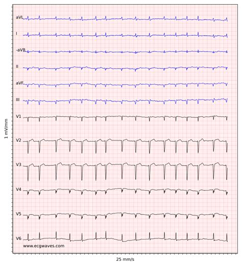 Atrial fibrillation: ECG, classification, causes, risk factors ...