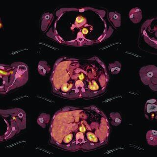 Pet Ct Fdg En Paciente Con Vasculitis De Grandes Vasos Cortes Axiales