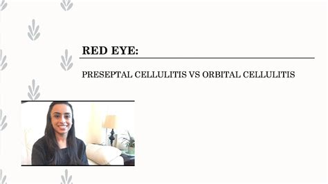 Preseptal Cellulitis Vs Orbital Cellulitis Youtube