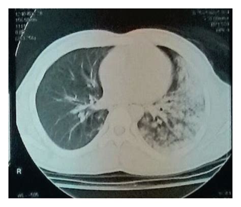 3 Ct Scan Images Classifying Lung Contusions A Total Areas On The