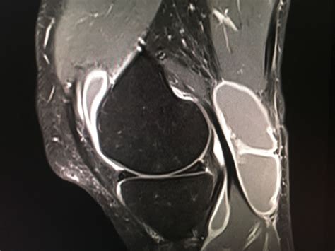 Baker S Cyst X Ray Image At Donald Harding Blog