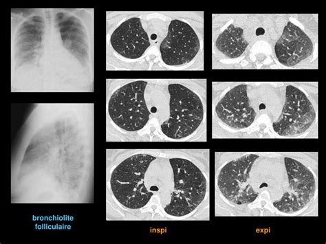 Ppt Le Syst Me Lymphatique Du Parenchyme Pulmonaire Et Sa Pathologie