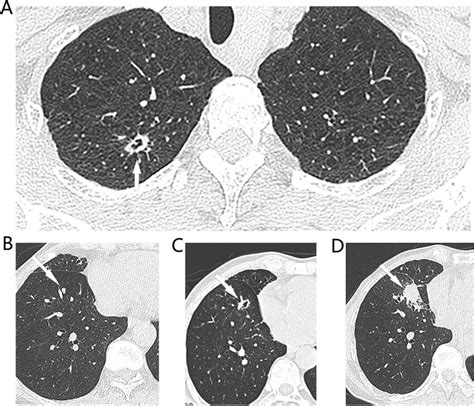 Typical Ct Images Of Synchronous Multiple Primary Lung Cancers A On