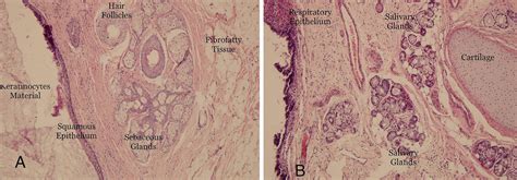 A Mature Teratoma With Ectodermal Components Consists Of Cyst Wall