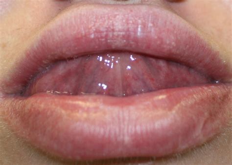 Fordyce Spots On Corner Of Lips Treatment Lipstutorial Org