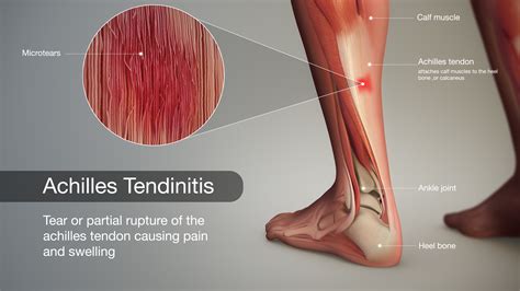 Achilles Tendon Rupture 3d Medical Aniamtion Still Shot Depiction