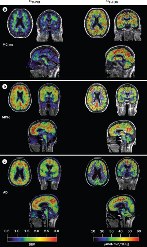 Fusion Images From Coregistered Pet And Mri Scans C Pib Retention Is