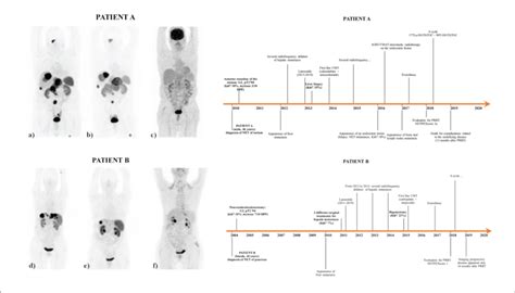 68 Ga DOTATOC PET CT Pre Therapy A And Post Therapy B And 18