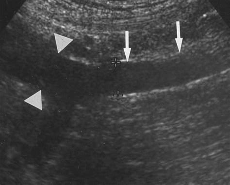 Diagnosis Of Pelvic Congestion Syndrome Using Transabdominal And